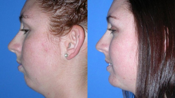 chin augmentation