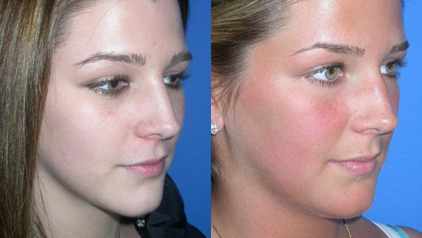 Rhinoplasty