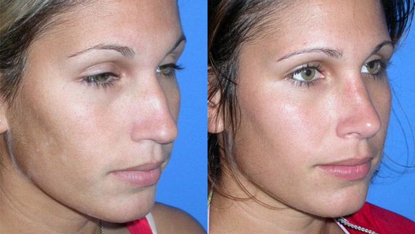 Rhinoplasty