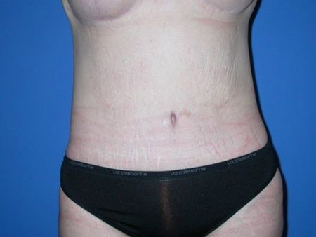 after belt lipectomy