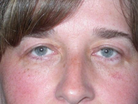 blepharoplasty