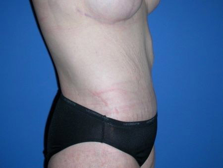 after belt lipectomy