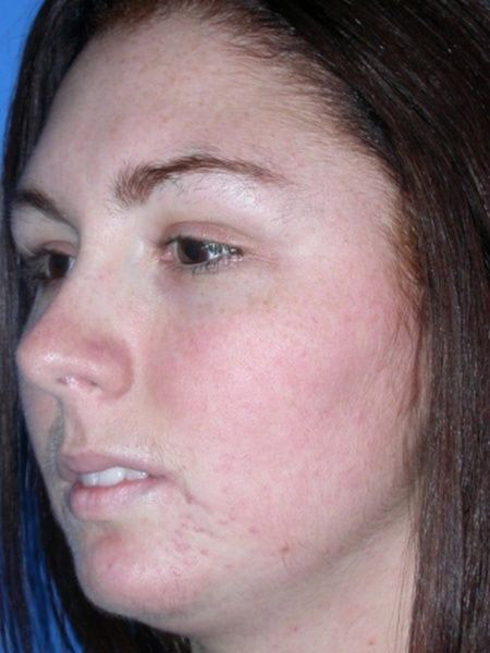 chin augmentation