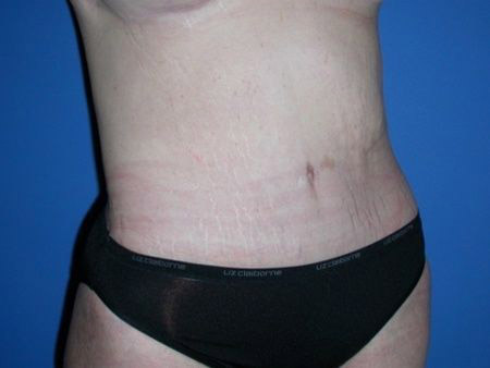 after belt lipectomy