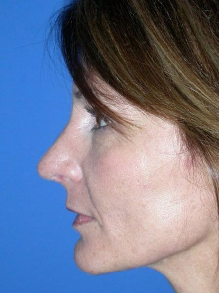 Rhinoplasty