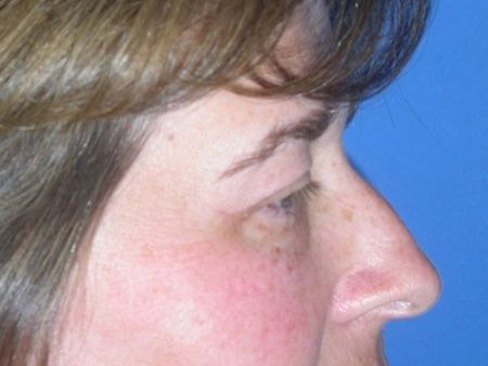 blepharoplasty