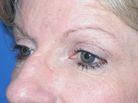 brow lift