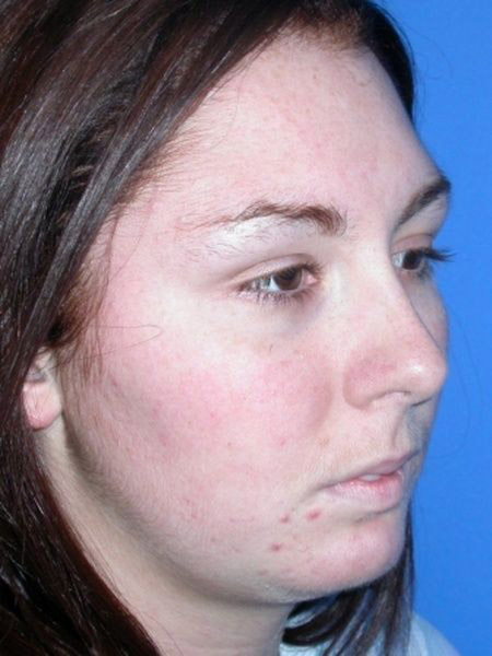 chin augmentation