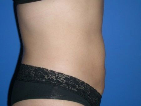 after Liposuction Abdomen