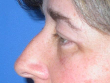 blepharoplasty