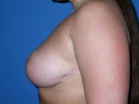 breast reduction