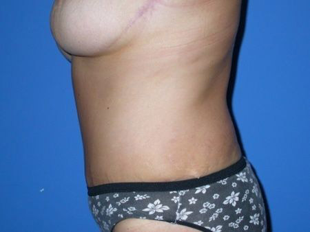 after abdominoplasty