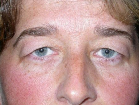 blepharoplasty