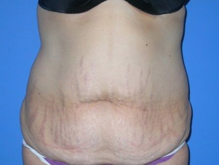 before abdominoplasty