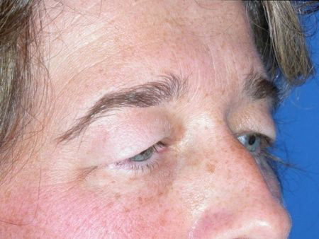 blepharoplasty