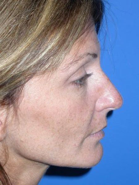 Rhinoplasty