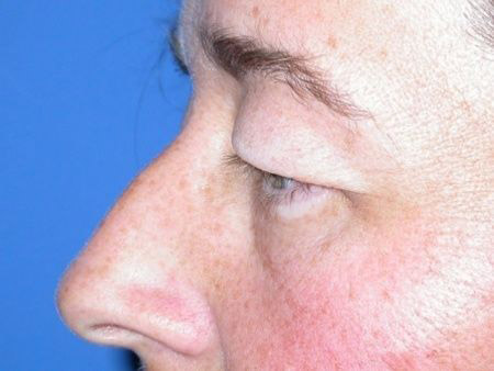 blepharoplasty