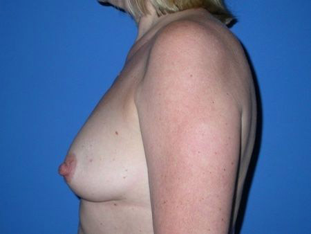 breast reconstruction