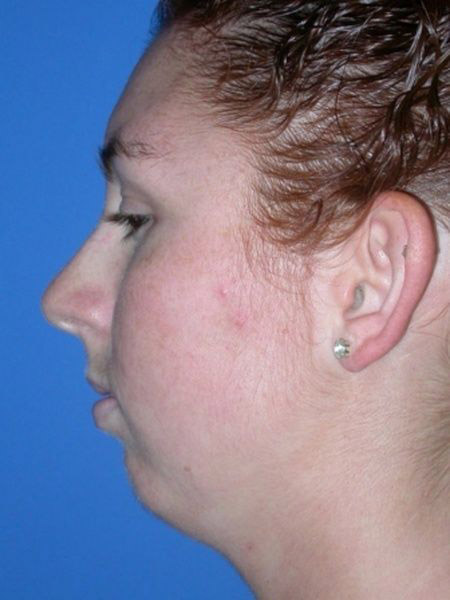 chin augmentation