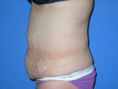 before abdominoplasty