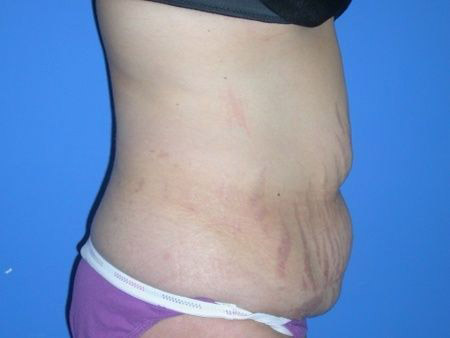 before abdominoplasty