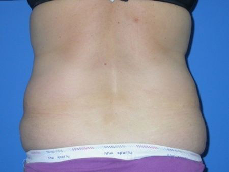 before abdominoplasty