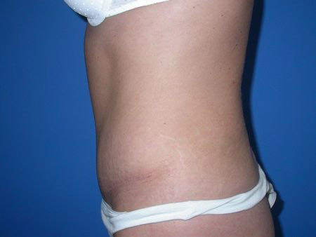 after abdominoplasty