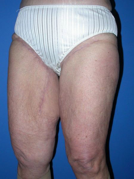 after thighplasty