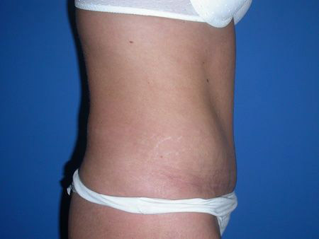 after abdominoplasty