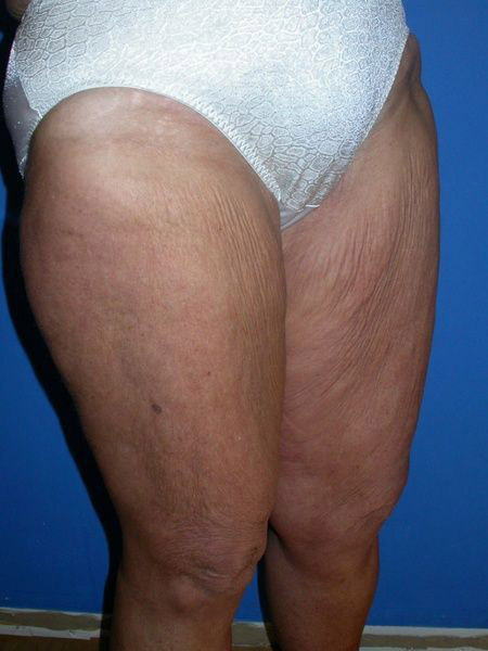 after thighplasty