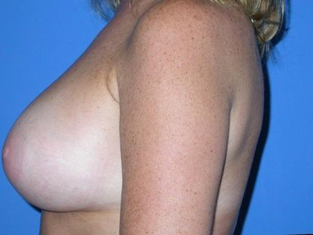 breast augmentation