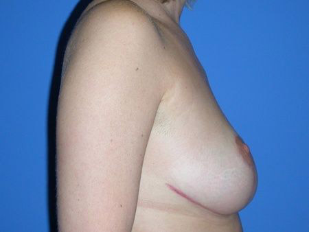 breast reduction