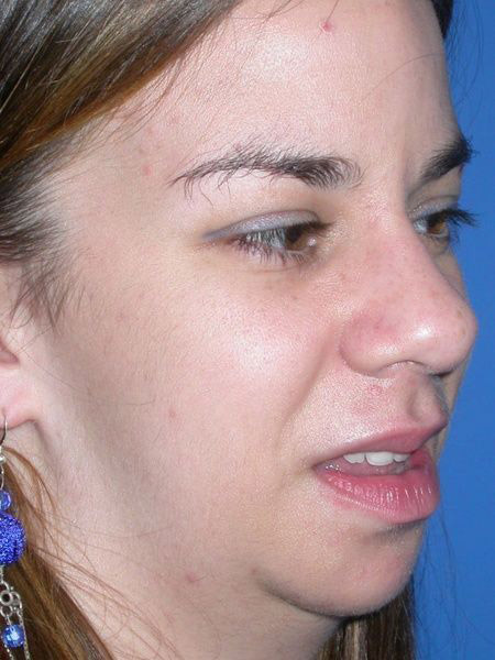 chin augmentation