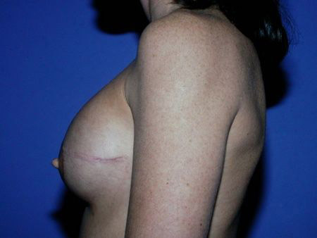 breast reconstruction