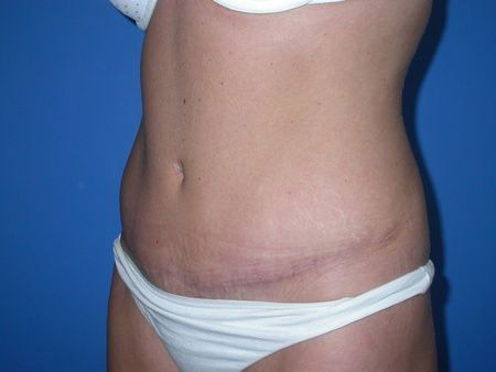 after abdominoplasty