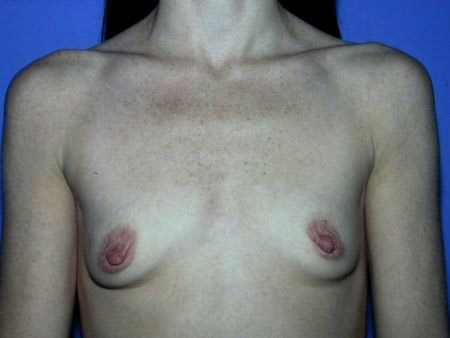 breast reconstruction