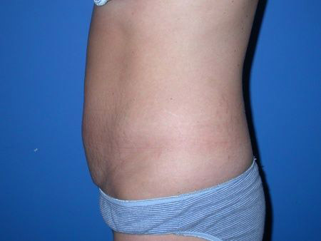 before abdominoplasty