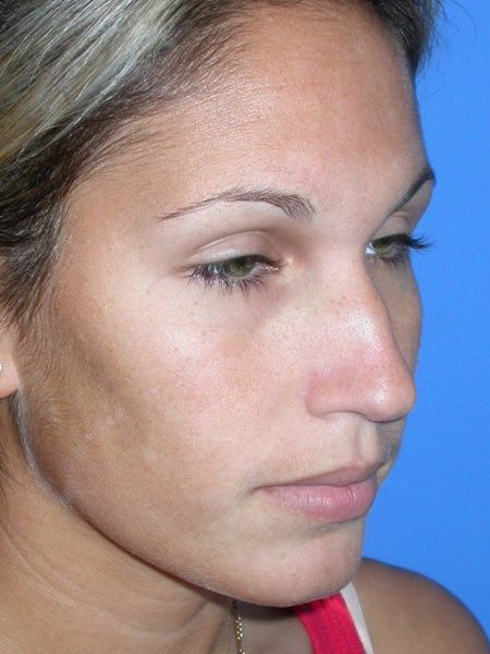 Rhinoplasty