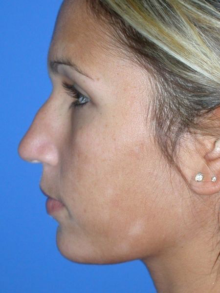 Rhinoplasty