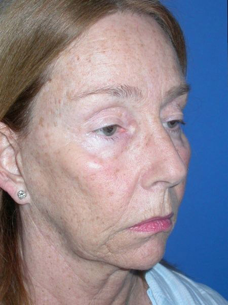 blepharoplasty