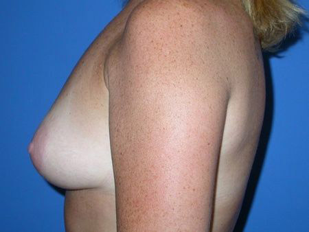 breast augmentation