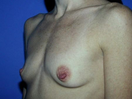 breast reconstruction