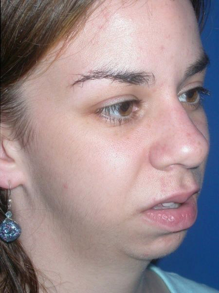 chin augmentation