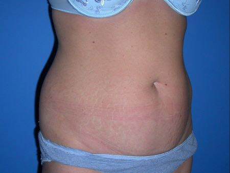 before abdominoplasty