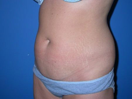 before abdominoplasty