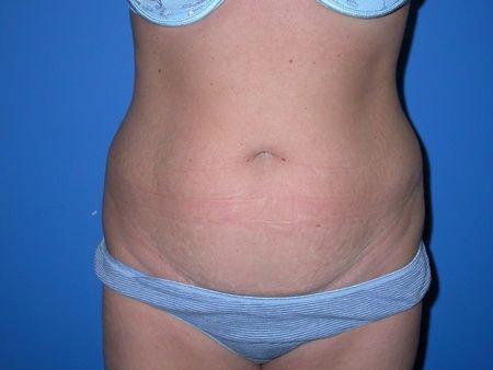 before abdominoplasty