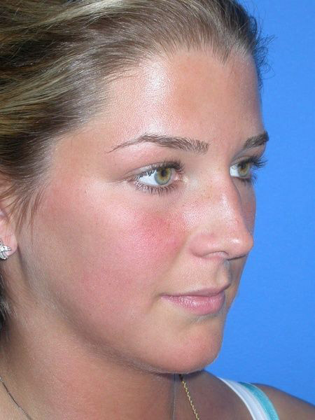 Rhinoplasty