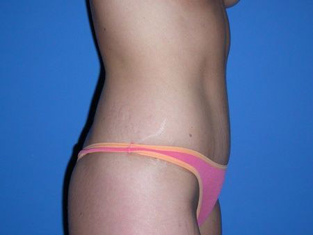 after abdominoplasty