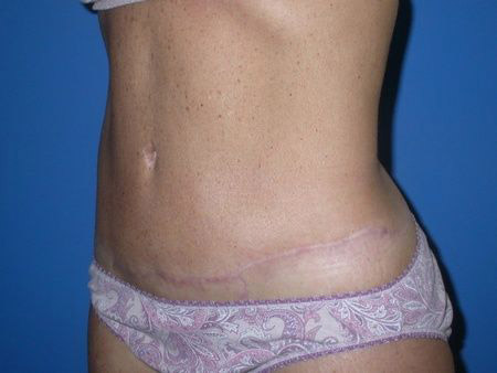 after belt lipectomy