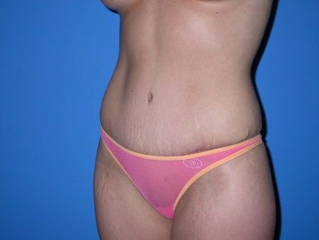 after abdominoplasty